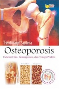 Osteoporosis : deteksi dini, penanganan, dan terapi praktis